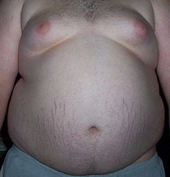 belly fat